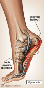 hielpijn-hielspoor-hielpijncentrum twente-shockwave hielspoor-fasciitis plantaris-fysio nijverdal-fysio hellendoorn