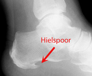 hielspoor-nijverdal-fysio nijveral-fysio hellendoorn-shockwave-hielpijn-echo-dry needling-zooltjes-hielpijn centrum twente